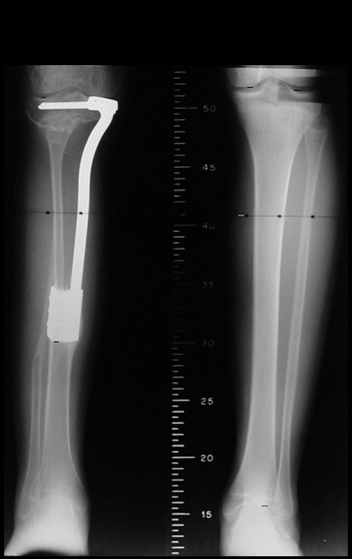 Figura 81: Escanograma de 07/11/2000, após um ano da cirurgia, evidenciando a horizontalização dos parafusos e o alinhamento do joelho.