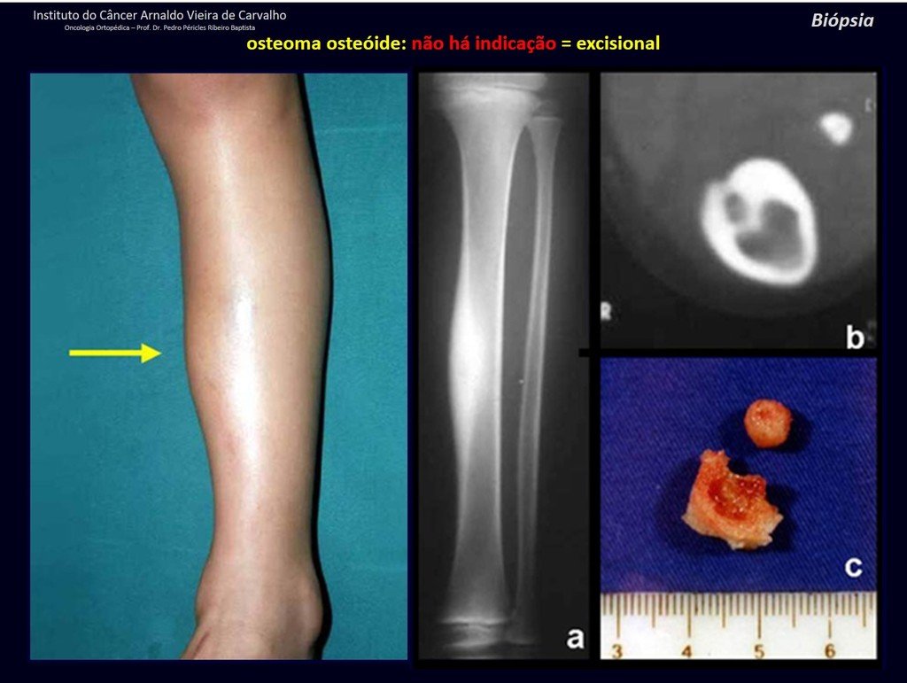 Figura 23: Osteoma osteóide da cortical anterior da tíbia. Não ha indicação de biópsia.