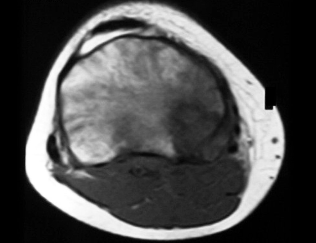 Figura 6: RM ax T1, lesão de baixo sinal e sinal intermediário, na porção póstero medial da região metafisária proximal da tíbia direita.