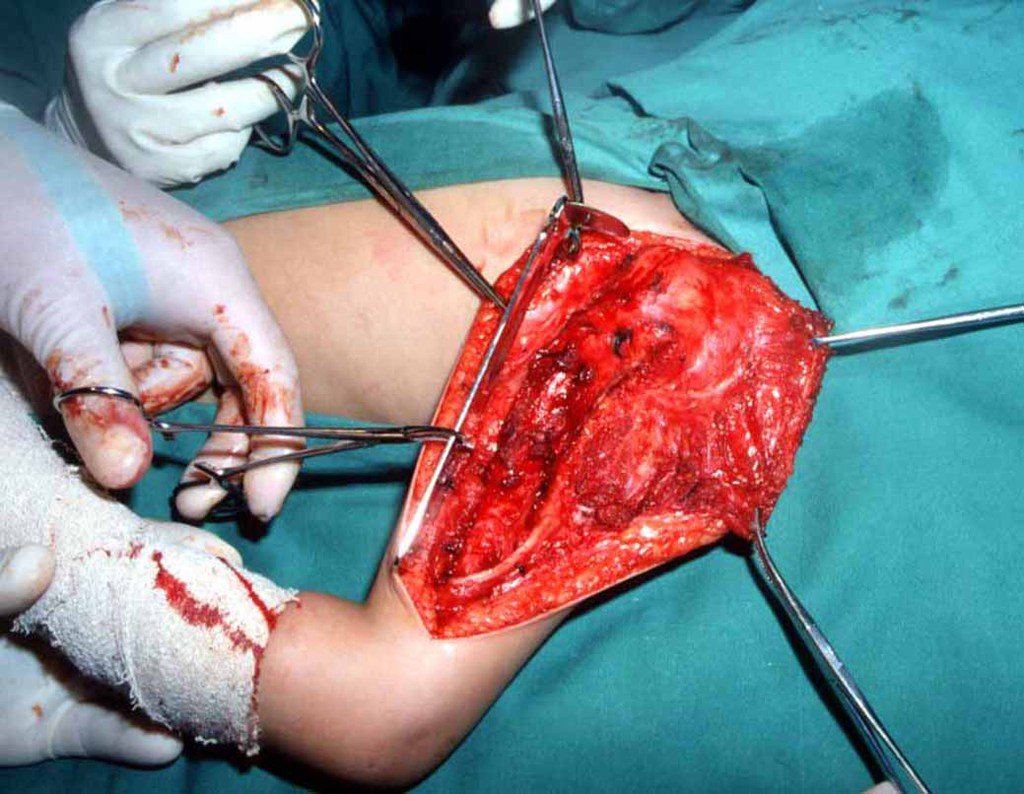 Figura 5: Cirurgia em 20/05/1991, dissecção de pele e tecido celular subcutâneo e exposição do segmento de úmero a ser ressecado. Nervo radial isolado e estudo da colocação da placa.