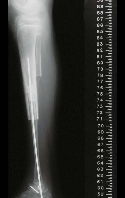 Figura 22: Radiografia perfil da reconstrução com a fíbula vascularizada, fixada com fio intramedular.