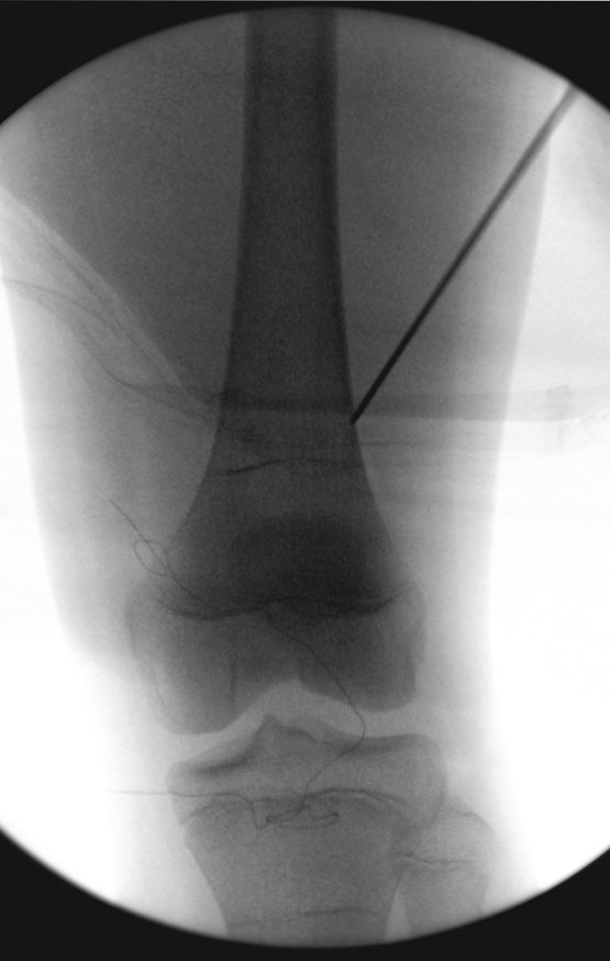 Figura 173: Introdução do fio guia até tocar a cortical lateral e conferência da orientação na radioscopia.