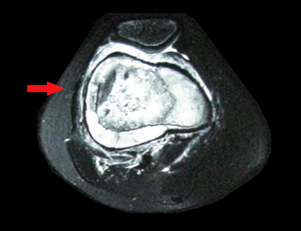 Figura 17: RM axial fat T1, com intensa captação de gadolínio. A seta aponta o periósteo deslocado e crescimento de tumor entre o periósteo e a cortical.