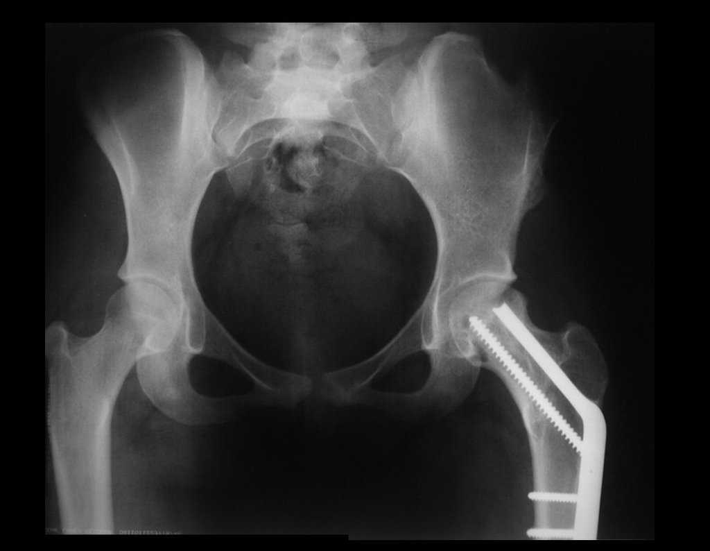 Figura 95: Radiografia da bacia frente, com os quadris simétricos e com a integração total do enxerto autólogo, reconstituindo o colo femoral.