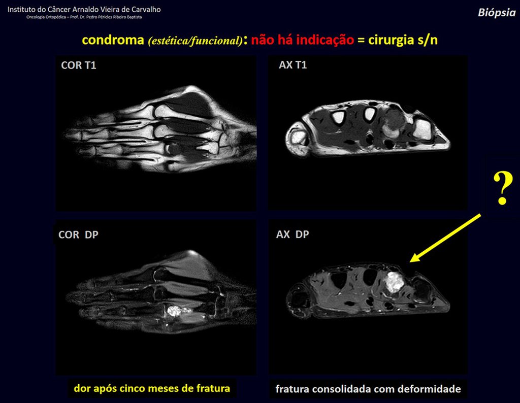 Figura 35: Ressonância de condroma da falange após fratura há cinco meses, com DOR!