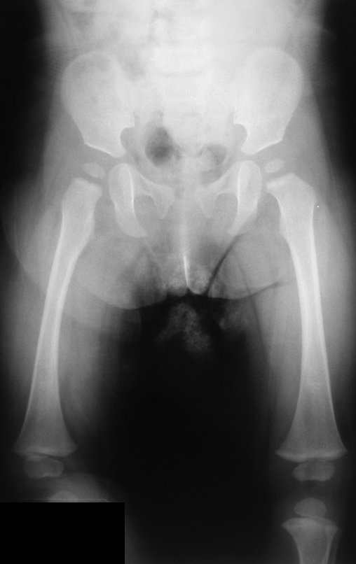 Figura 1: Radiografia panorâmica de membros inferiores, frente, realizada em 25 de janeiro de 2008, sem alterações na bacia ou fêmures.