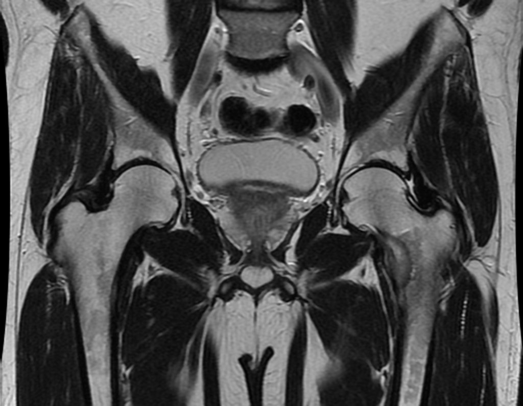 Figura 5: RM coronal stir, lesão de sinal intermediário na face medial do fêmur esquerdo.