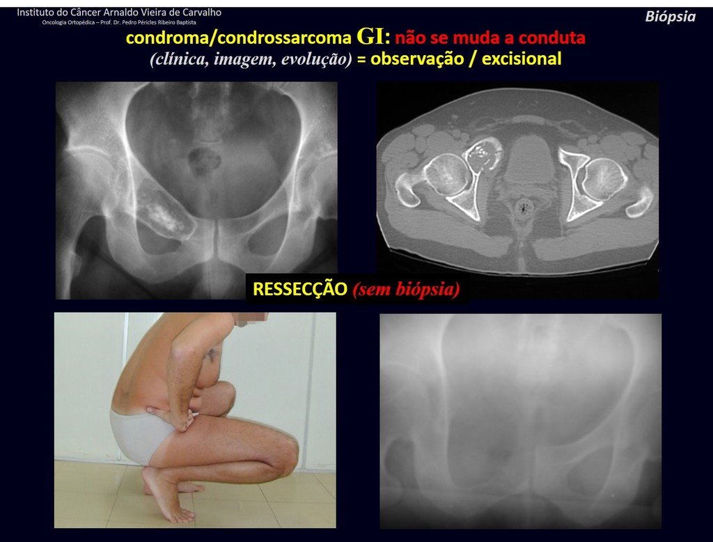 Figura 44: Lesão cartilaginosa no ramo ílio-púbico direito. Acompanhada havia dois meses, houve piora da imagem, com ruptura da cortical! Foi operado como condrossarcoma, com ressecção segmentar da lesão, sem a realização de biópsia, pois independente do resultado, fosse este condroma ou condrossarcoma o tratamento deve ser cirúrgico, com ressecção ampla.