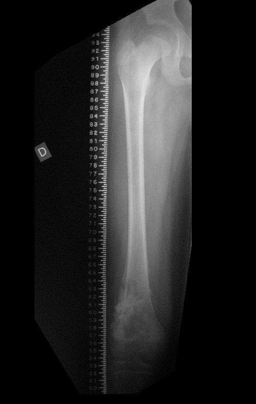 Figura 24: Radiografia coronal, com régua para o desenho da endoprótese e planejamento da cirurgia.