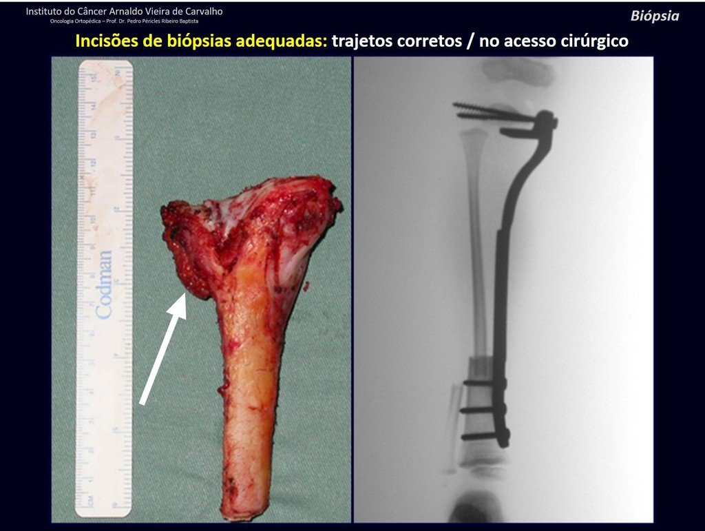 Figura 84: Peça ressecada com margem, incluindo o trajeto da biópsia. Reconstrução com dispositivo de fixação interna extensível e autotransplante com a cartilagem de crescimento da fíbula.