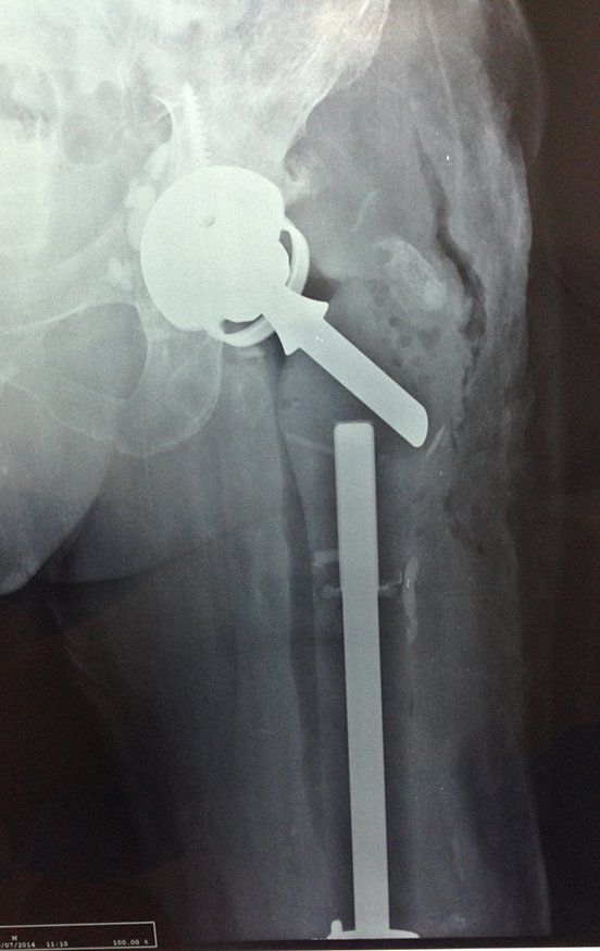 Figura 81: Radiografia do pós-operatório imediato da revisão com acetábulo bloqueado.