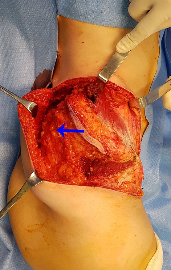 Figura 106: Dissecção pelo plano gorduroso, que reveste os músculos glúteos a serem ressecados como margem. Hemostasia cuidadosa, não há sangramento.