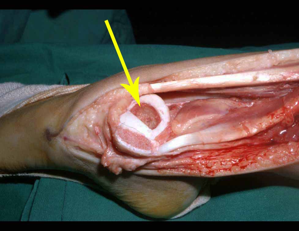 Figura 13: Realização de uma cavidade no tálus para colocação da epífise fibular visando obter a artrodese fíbulotalar.