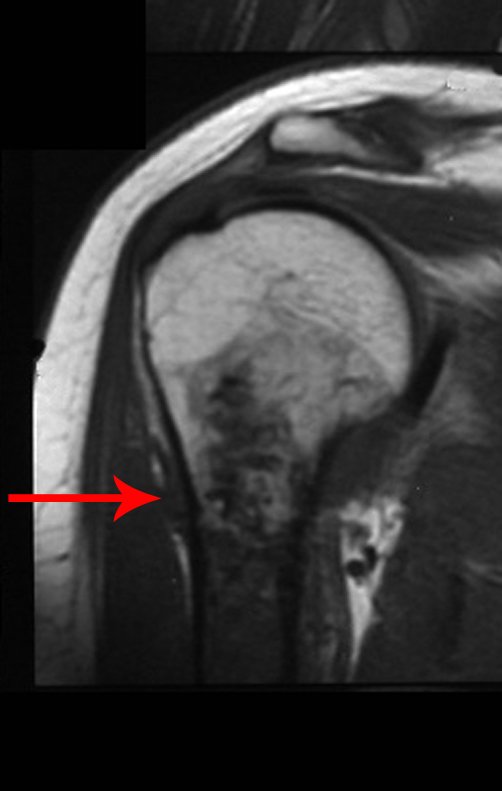 Figura 8.A: Rm cor T1, observa-se o levantamento periosteal e lesão extra cortical.