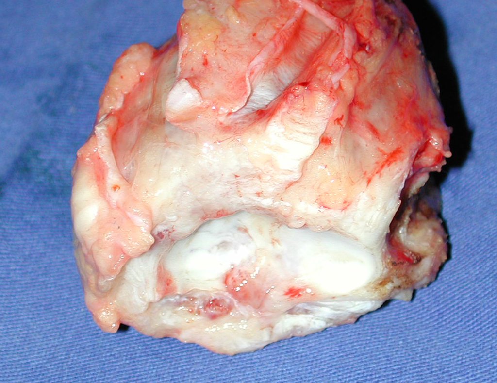 Figura 52: Face articular, sem lesão da superfície, os sulcos dos túneis tendinosos salientam os limites oncológicos da ressecção.