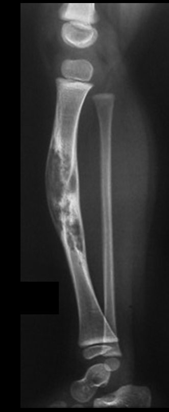 Figura 23: Evolução na radiografia de perfil, em 17/03/2009.