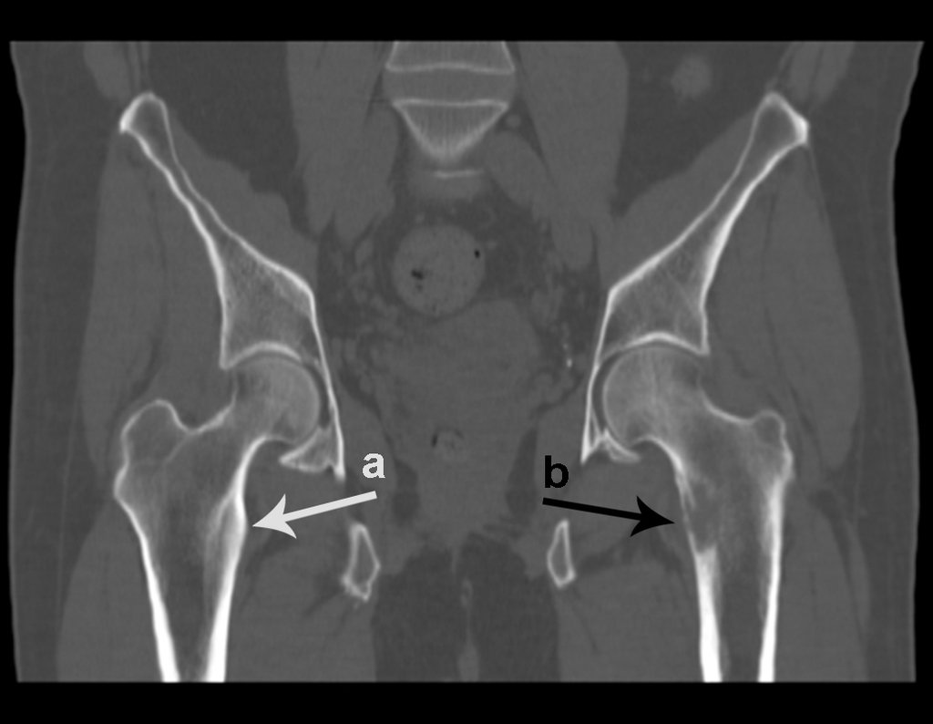 Figura 12: Tomografia em corte coronal, lesão lítica e erosão da cortical medial à esquerda, seta b.