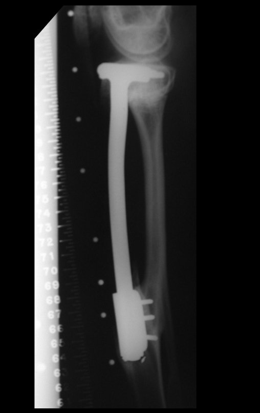 Figura 101: Escanograma de 07/08/2001, perfil, com a fise fibular encerrando o seu crescimento e a perna operada ligeiramente mais curta, devido à perda no pós-operatório precoce, já comentado.