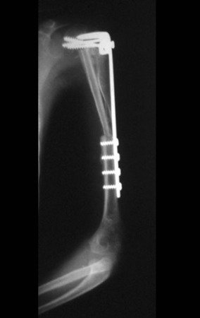 Figura 15: Radiografia de controle em 15/07/1991, frente.