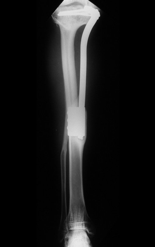 Figura 140: Radiografia de 30/03/2004, após quatro anos e cinco meses, com boa hipertrofia da fíbula e bom alinhamento do membro operado.