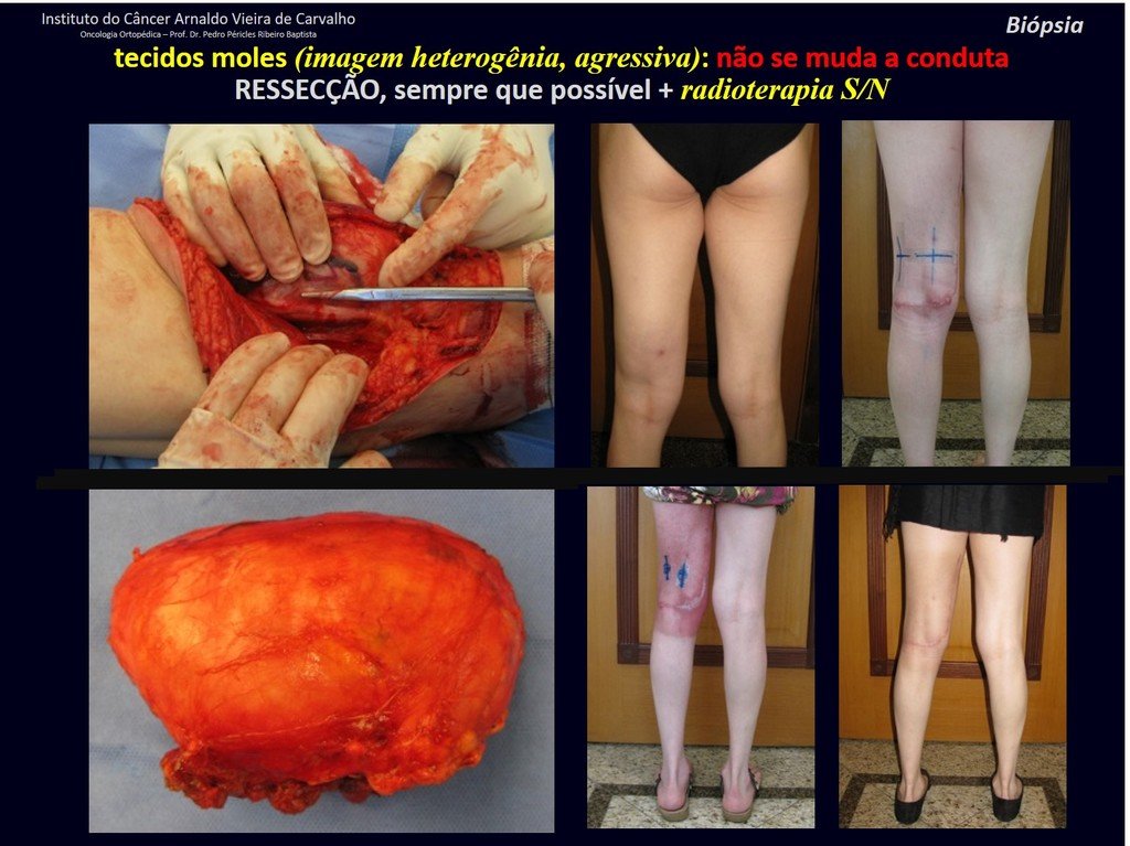 Figura 78: Ressecção com margens exíguas, apenas com sua pseudocápsula, liberando-se o nervo da lesão. Patologia confirma a hipótese de lipossarcoma mixóide. Após a completa cicatrização da ferida operatória, é realizada a radioterapia adjuvante.