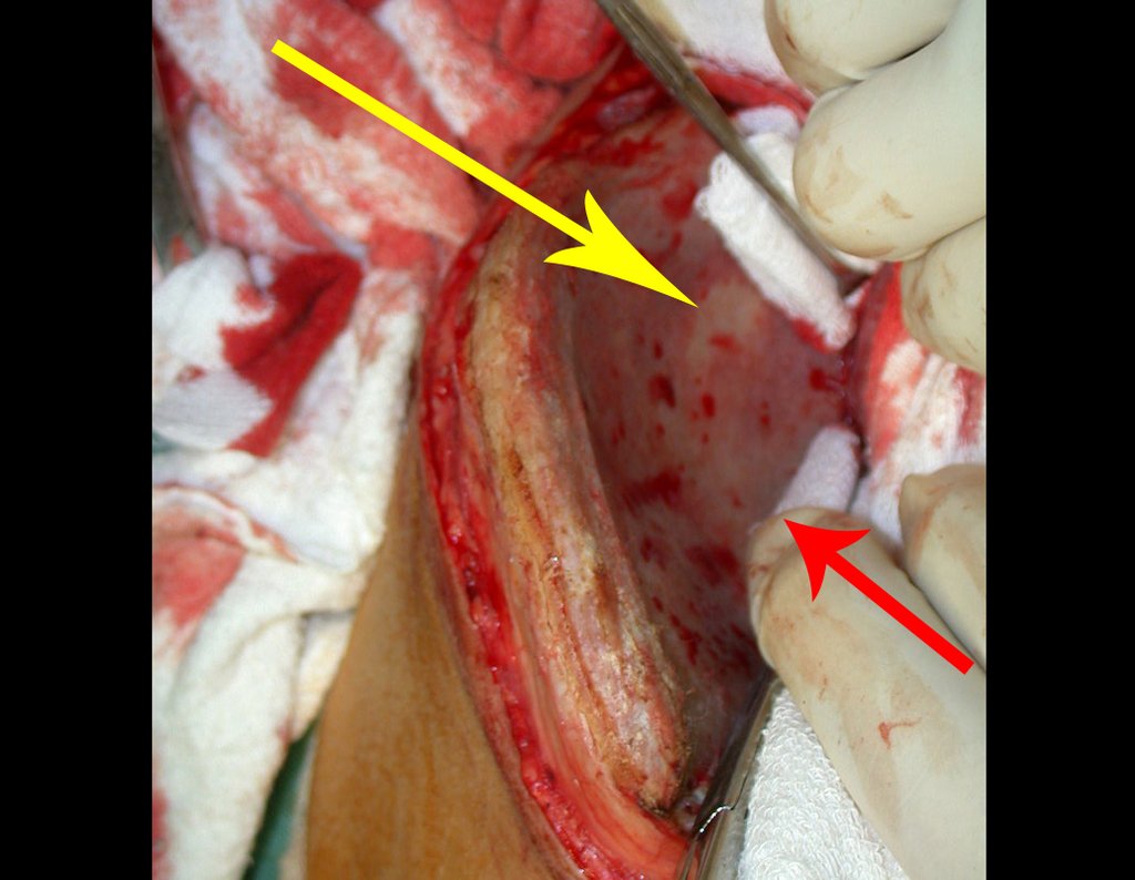 Figura 15: Hemostasia da tábua interna. Calibrosa artéria nutrícia, que é obliterada com cera para osso, seta vermelha. A seta amarela assinala a região clara, onde a tábua interna e a externa se fundem. NÃO HÁ ENXERTO AÍ!