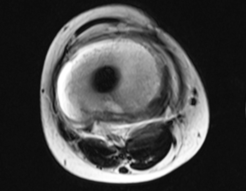 Figura 144: RM axial T2 fat-unil.