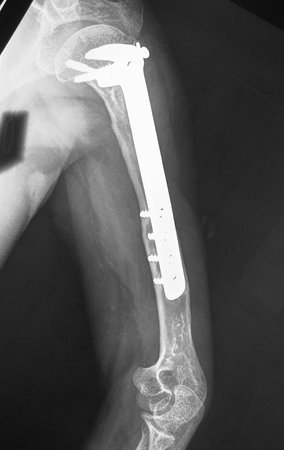 Figura 29: Radiografia de controle, oblíqua, após 22 anos.