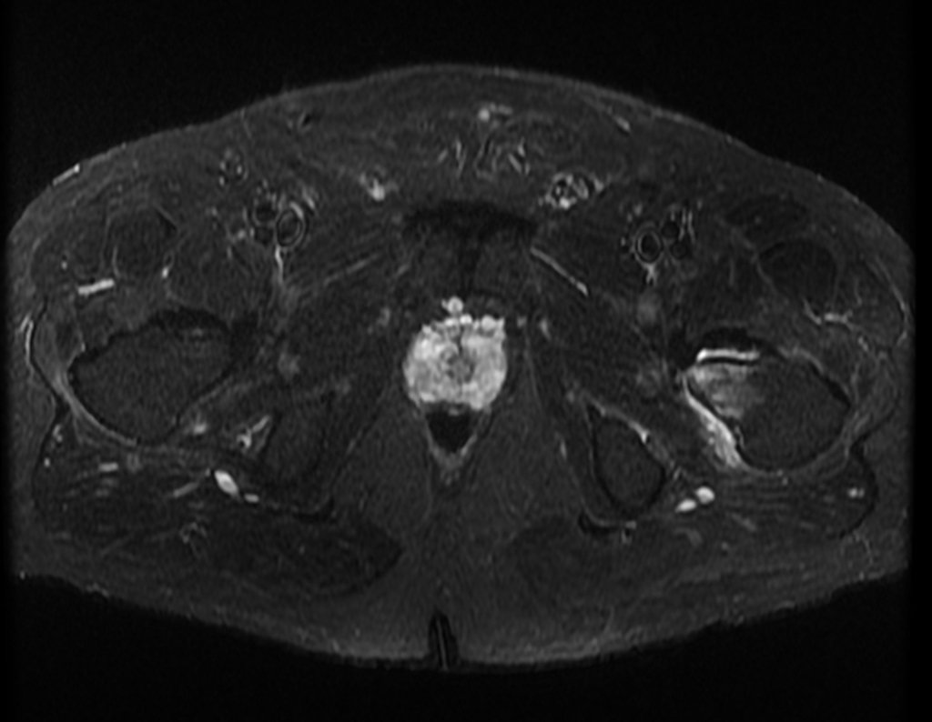 Figura 8: Corte axial com a lesão e edema no pequeno trocânter.