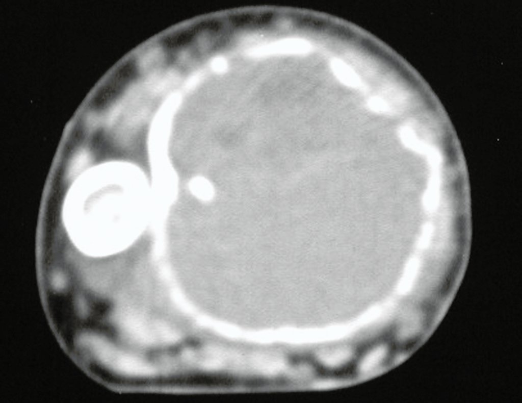 Figura 3: Tomografia, com densidade para tecidos moles, mostra a lesão epifisária lítica do rádio, com a cortical insuflada, sem tumor extracortical.