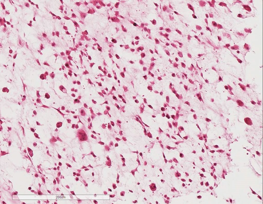 Figura 112: Neoplasia cartilaginosa, com mitoses atípicas e hipercromasia.