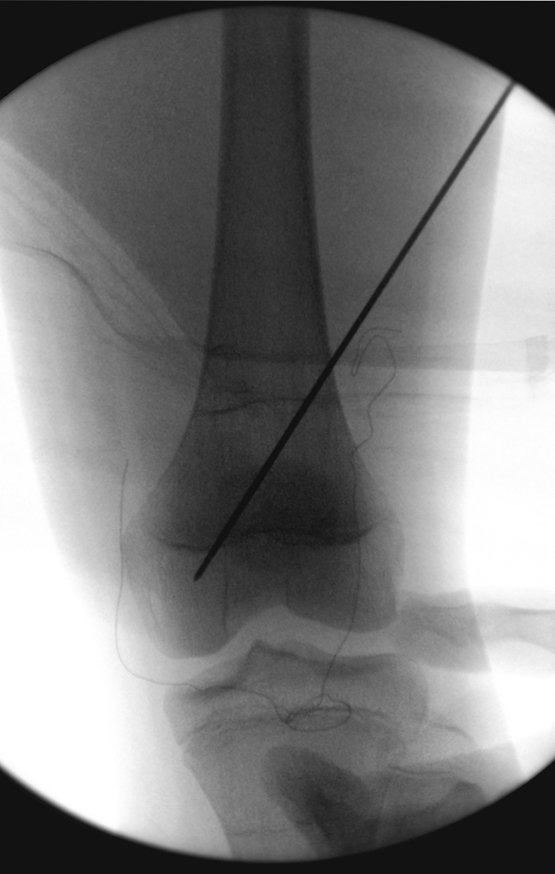 Figura 175: Aprofundamento do fio guia até o ponto final, no côndilo femoral.