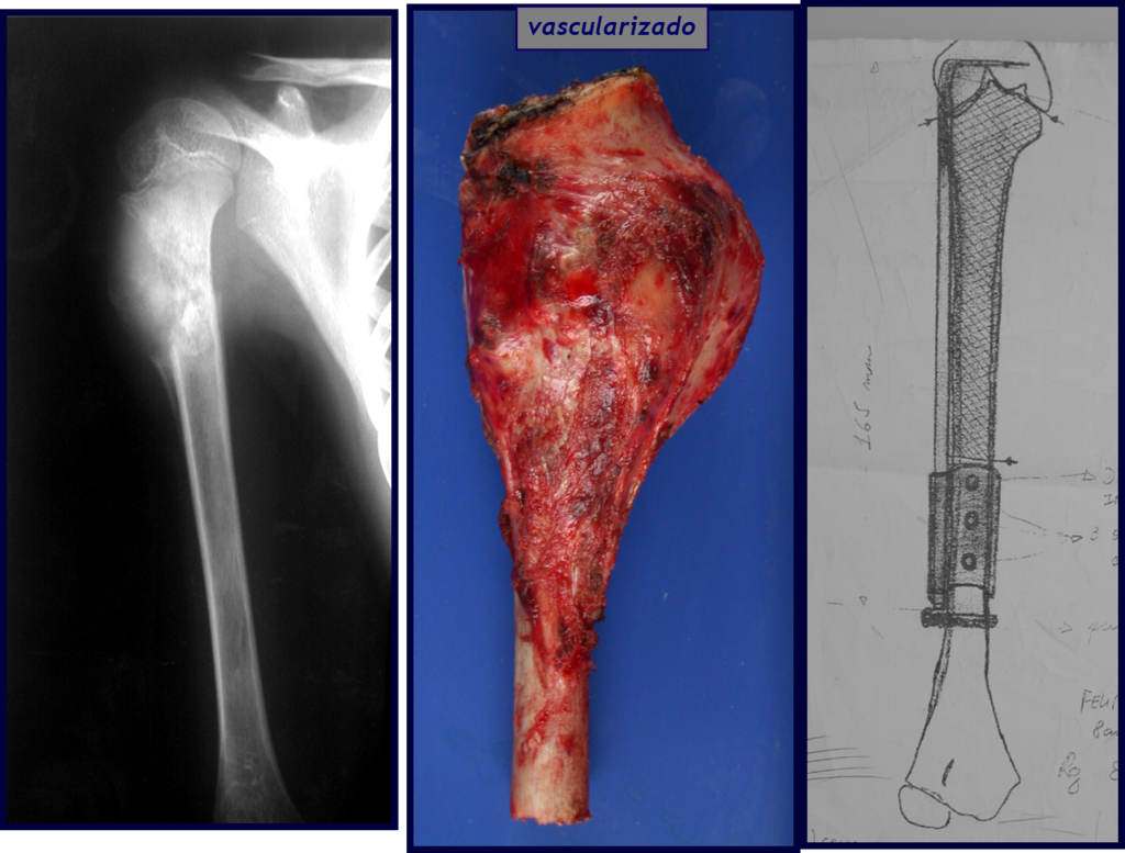 Figura 63: Sarcoma de Ewing do úmero, Quimioterapia + ressecção do tumor. Planejamento da reconstrução com dispositivo de fixação interna extensível.