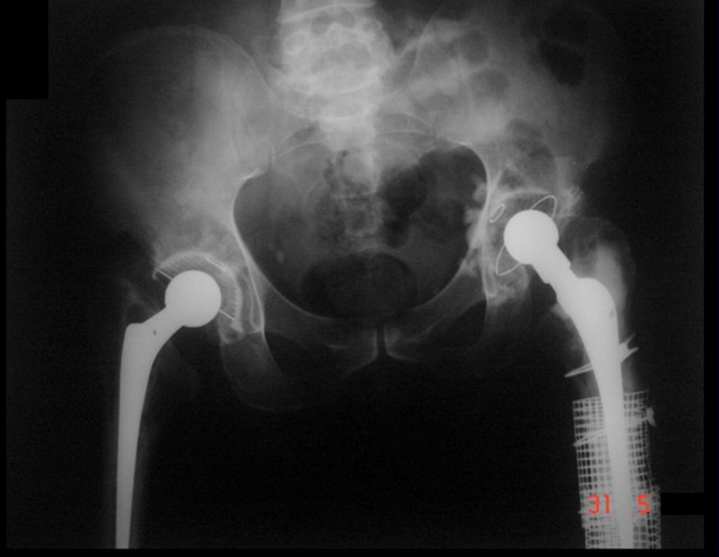 Figura 4: Revisão do quadril esquerdo com troca da prótese femoral, com colo longo, haste curta e placa com tela e cerclagem, em maio de 2008.