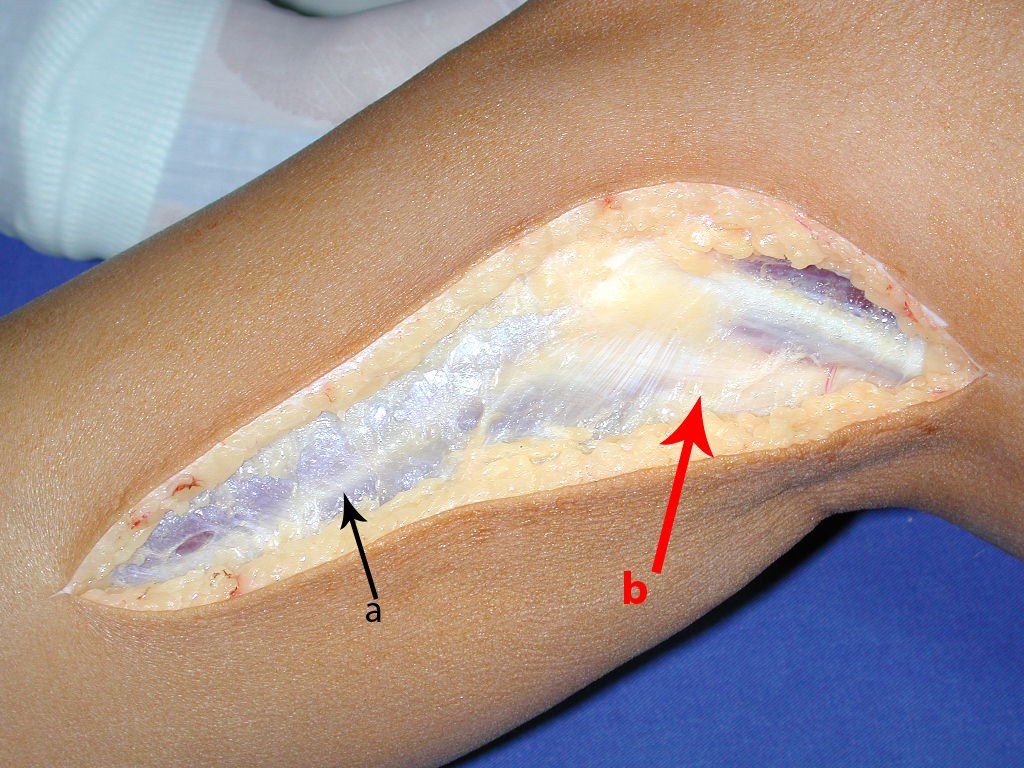 Figura 60: Abertura da pele e subcutâneo, hemostasia e exposição do perimísio dos músculos extensor e flexor longo dos dedos. A= septo que divide os compartimentos anterior e lateral da perna, e B= visualização do tecido gorduroso que envolve o nervo ciático poplíteo externo, sob a aponevrose.