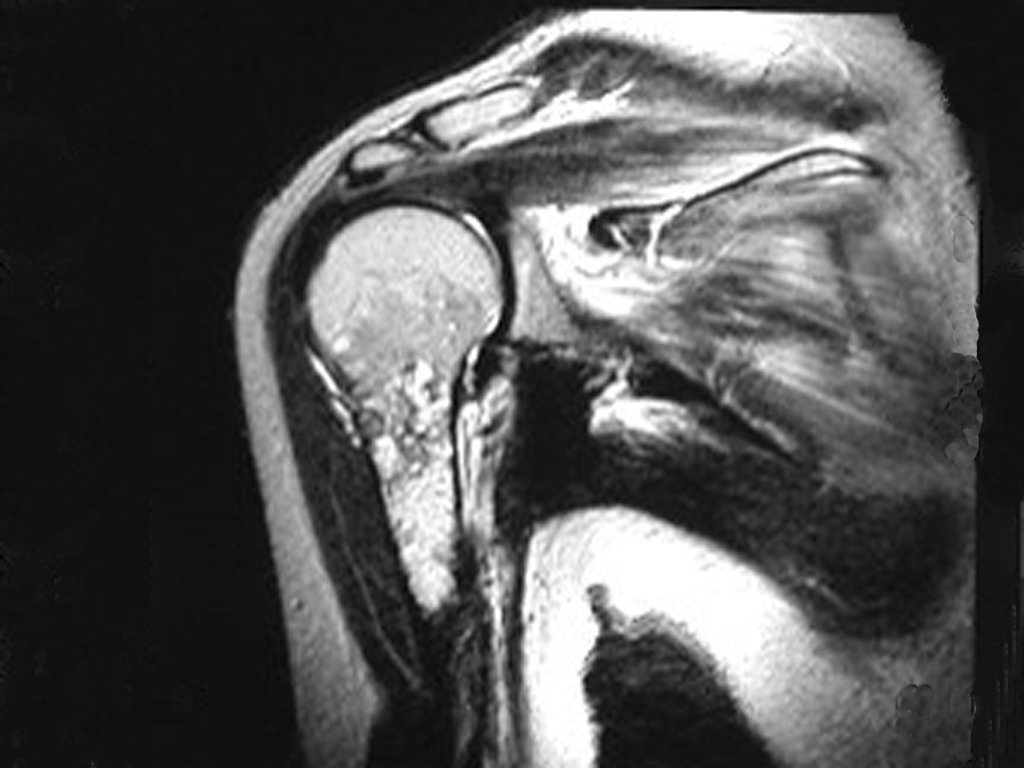 Figura 4: RM coronal (cor) T2, lesão heterogênea com áreas de alto sinal entremeadas com áreas de baixo sinal (focos de calcificação).