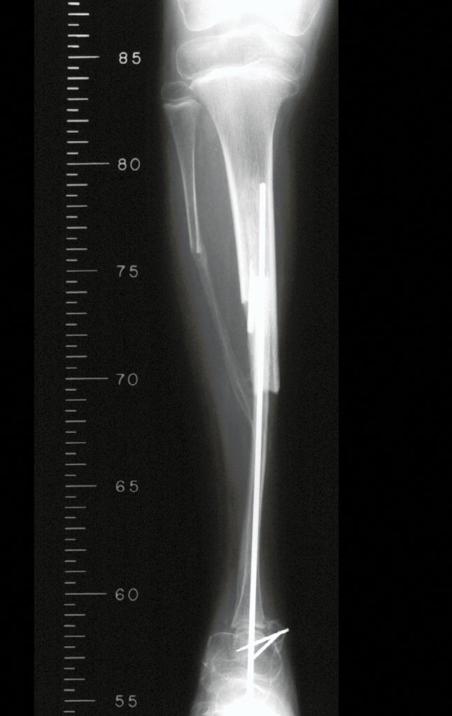 Figura 37: Radiografia frente, em 1998.