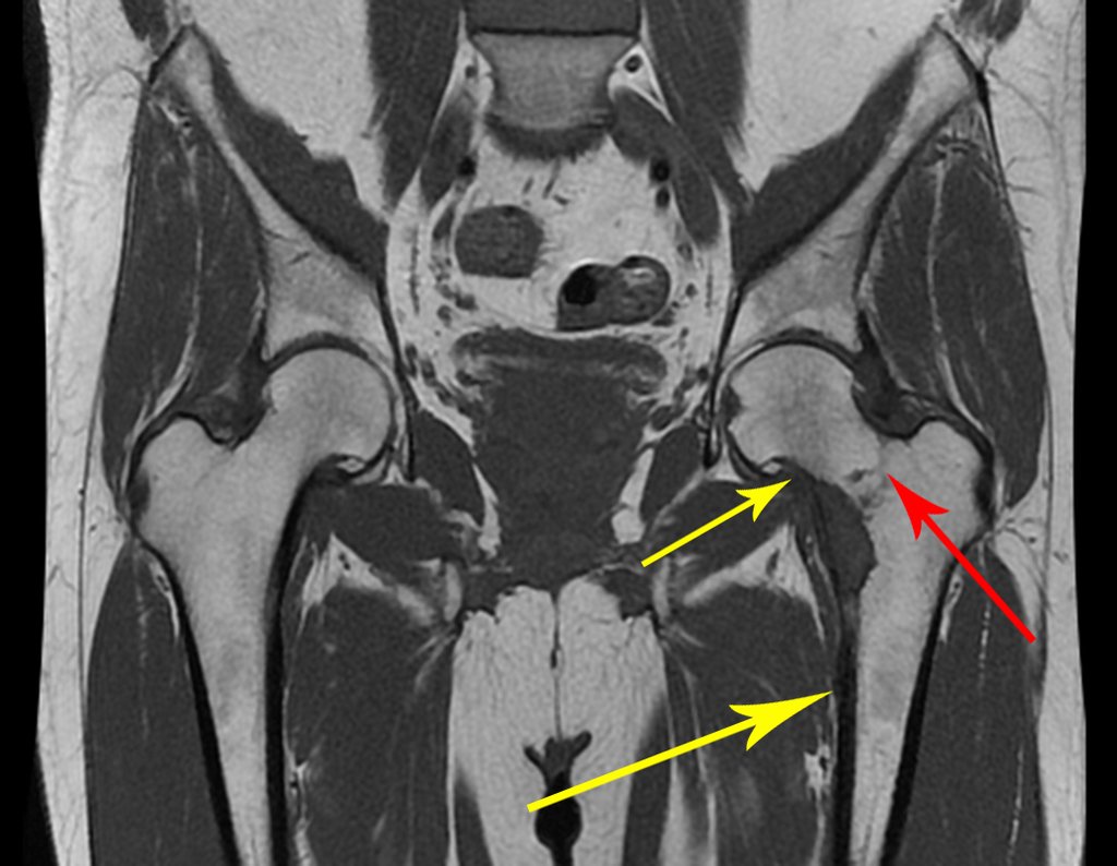 Figura 41: RM coronal T2 evidenciando traço de fratura incompleta no colo femoral, seta em vermelho, devido a aumento da erosão da cortical medial, entre as setas em amarelo, provavelmente devido à não ossificação após a radioablação.