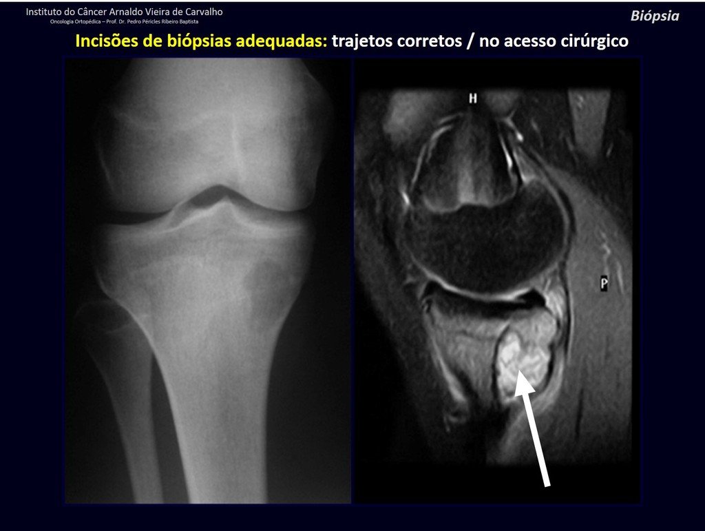 Figura 85: Radiografia e ressonância de osteossarcoma. A seta indica o ponto correto para a coleta da biópsia.