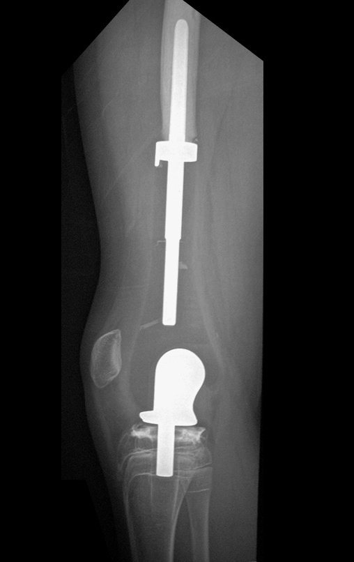 Figura 156: Radiografia de perfil, após dezessete meses, em 10/10/2015.