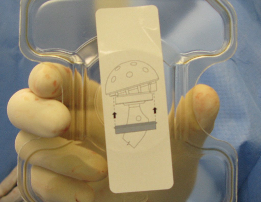 Figura 76: Novo componente acetabular, agora constrito.