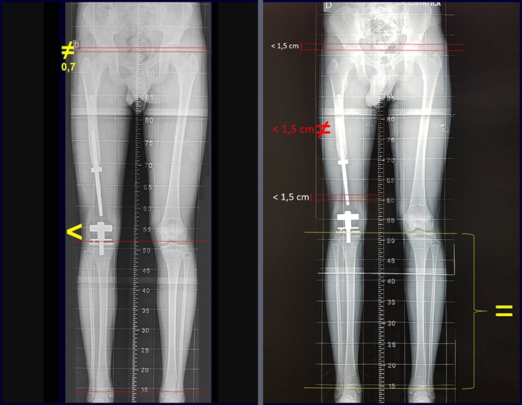 Figura 169: Comparação entre as medidas do escanograma de 09 de setembro de 2016 e 21 de janeiro de 2017. Aumento da discrepância de 0,7 para 1,5 cm, em cinco meses.