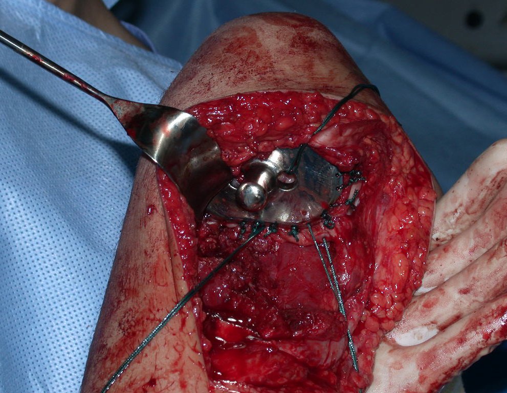 Figura 62: Componente de platô metálico da endoprótese, com pino central rotatório, totalmente fixado na cápsula articular do joelho e ancoragem da reconstrução ligamentar, colaterais e cruzados.