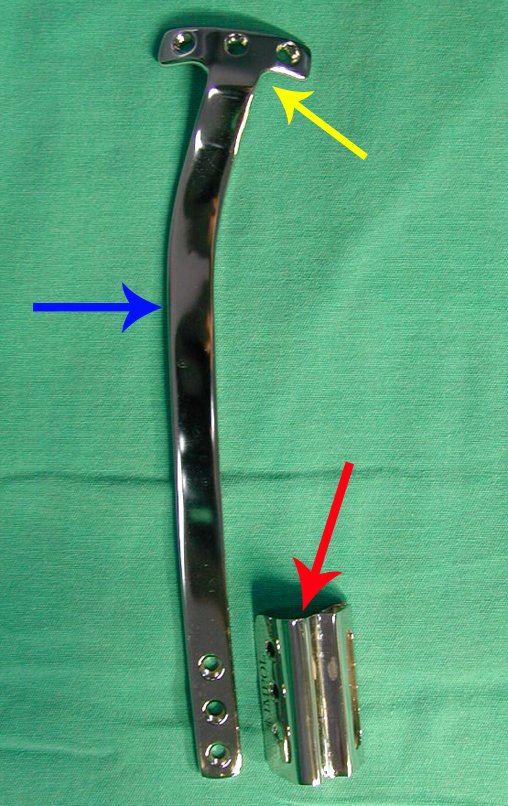 Figura 43: Dispositivo de fixação interna extensível, feito sob moldagem especial para este paciente. Segmento proximal em T, com três orifícios - seta amarela, haste confeccionada já curvelínea e pré modelada - seta azul e dispositivo de deslizamento triangular, para adaptação à tíbia , com encaixe - seta vermelha.