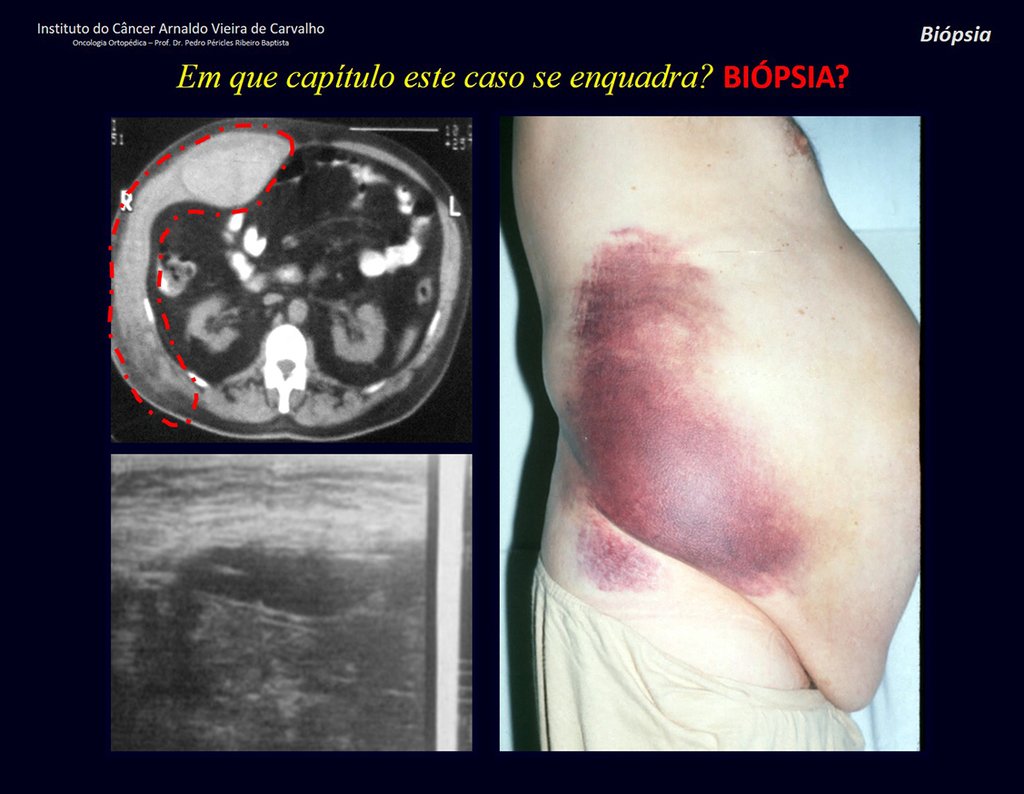 Figura 4: Tomografia, ultrassom e aspecto clínico. Paciente ictérico, asmático, com grande equimose, internado havia dias para investigação.