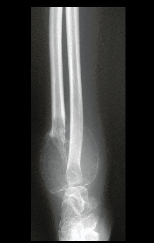 Figura 12: Aspecto radiográfico em 01/11/2000, antes da biópsia. Grande agressividade local do tumor.