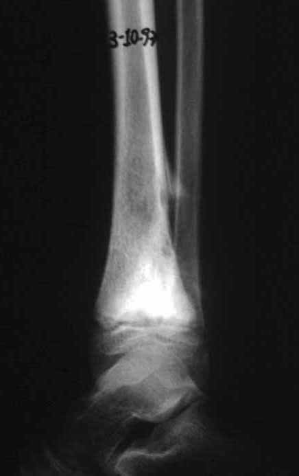 Figura 4: Radiografia em perfil de osteossarcoma do tornozelo, em quimioterapia.pré-operatória.