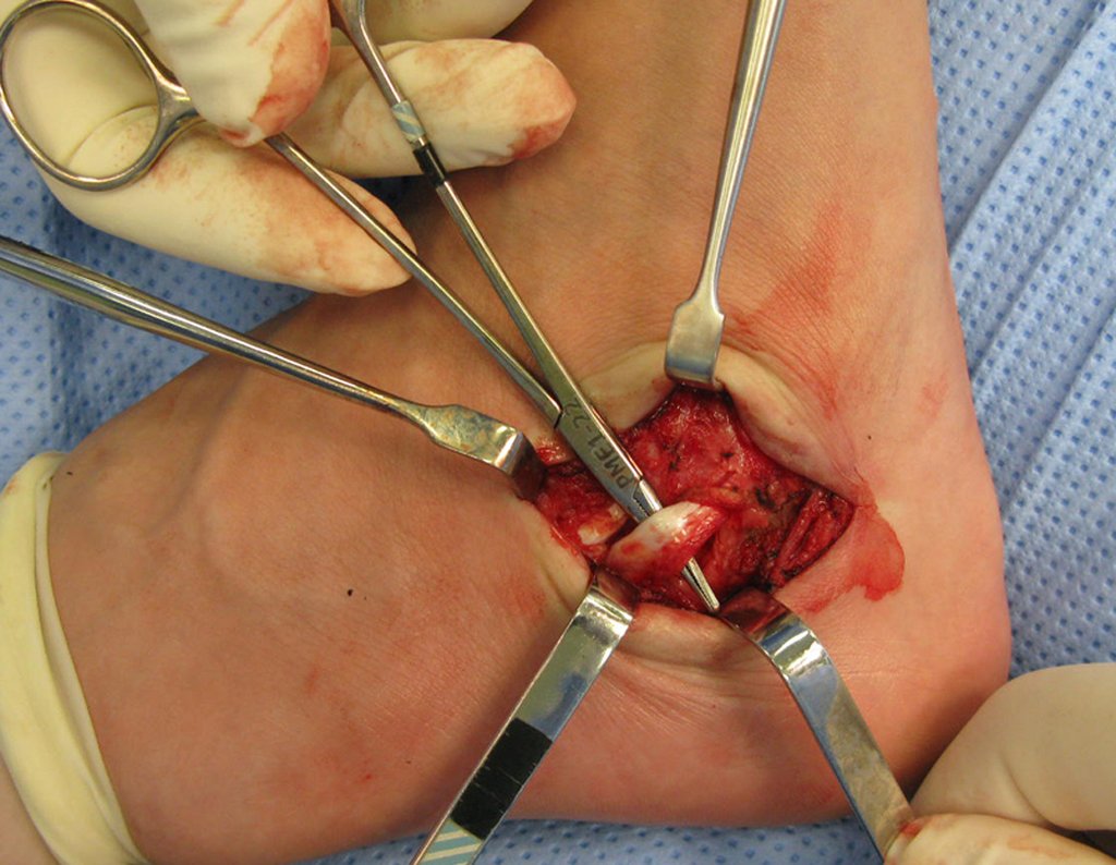 Figura 46: Visualização do tendão tibial posterior.