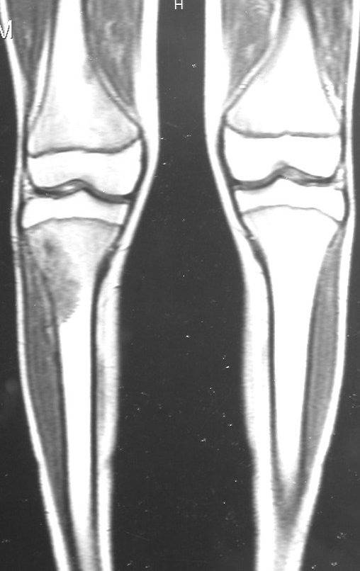 Figura 10: RM, coronal, de 02/10/1999, pós quimioterapia, com lesão na região lateral da metáfise proximal da tíbia direita e diminuição do volume tumoral extracortical.