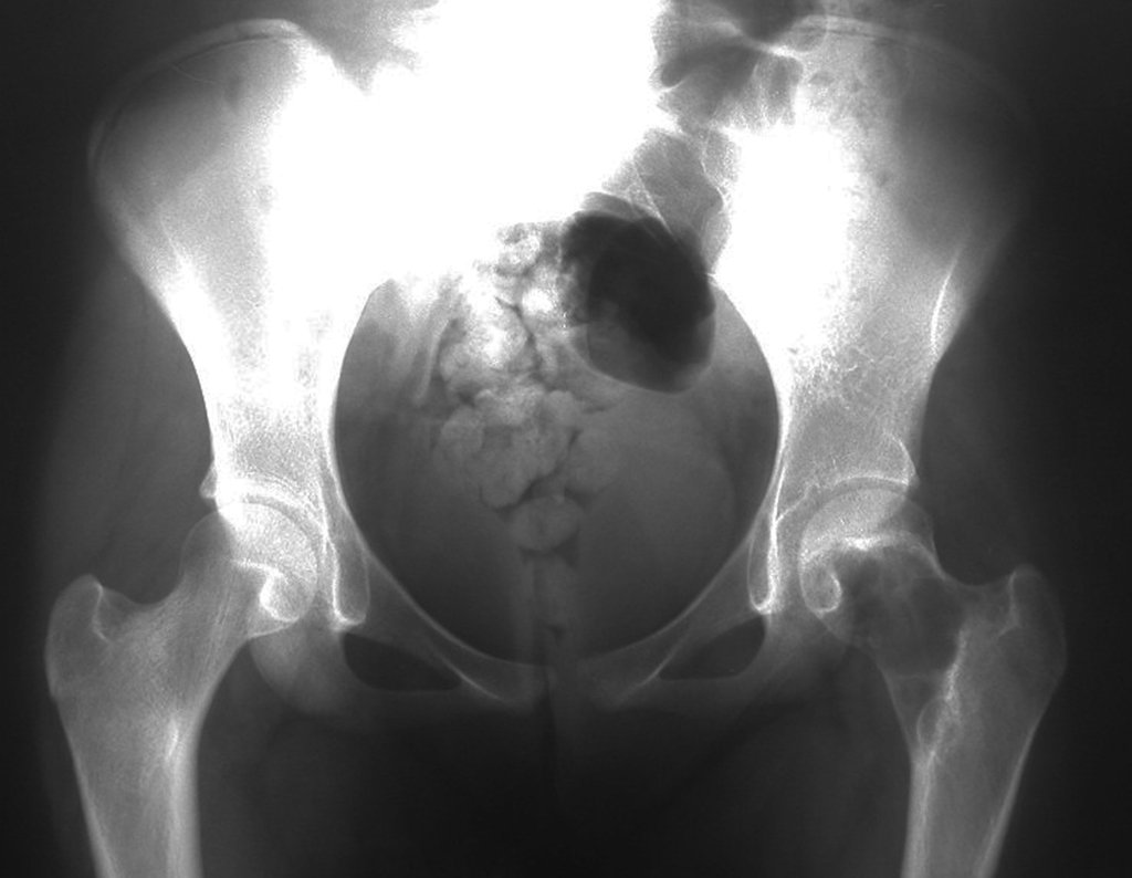 Figura 2: Radiografia da bacia, frente, de maio de 2014, apresentando lesão lítica no colo femoral esquerdo, com a cortical medial ainda íntegra (analise a imagem com o recurso da ampliação).